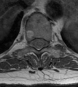 Hemangioma Spine